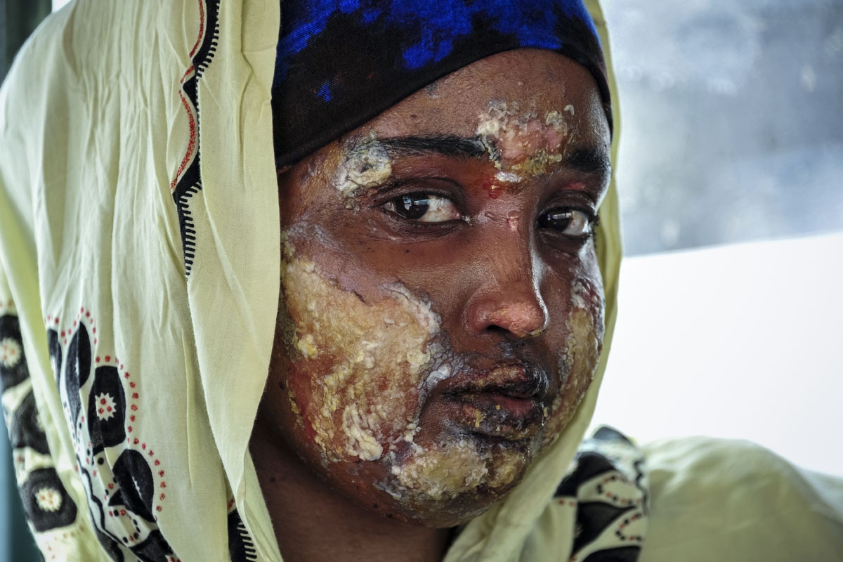 A Somalian burn victim, severely wounded by the latest truck bomb attack in Mogadishu, waits in an ambulance before being evacuated by aircraft to receive treatment, at the Aden Adde international airport in Mogadishu on October 17, 2017.