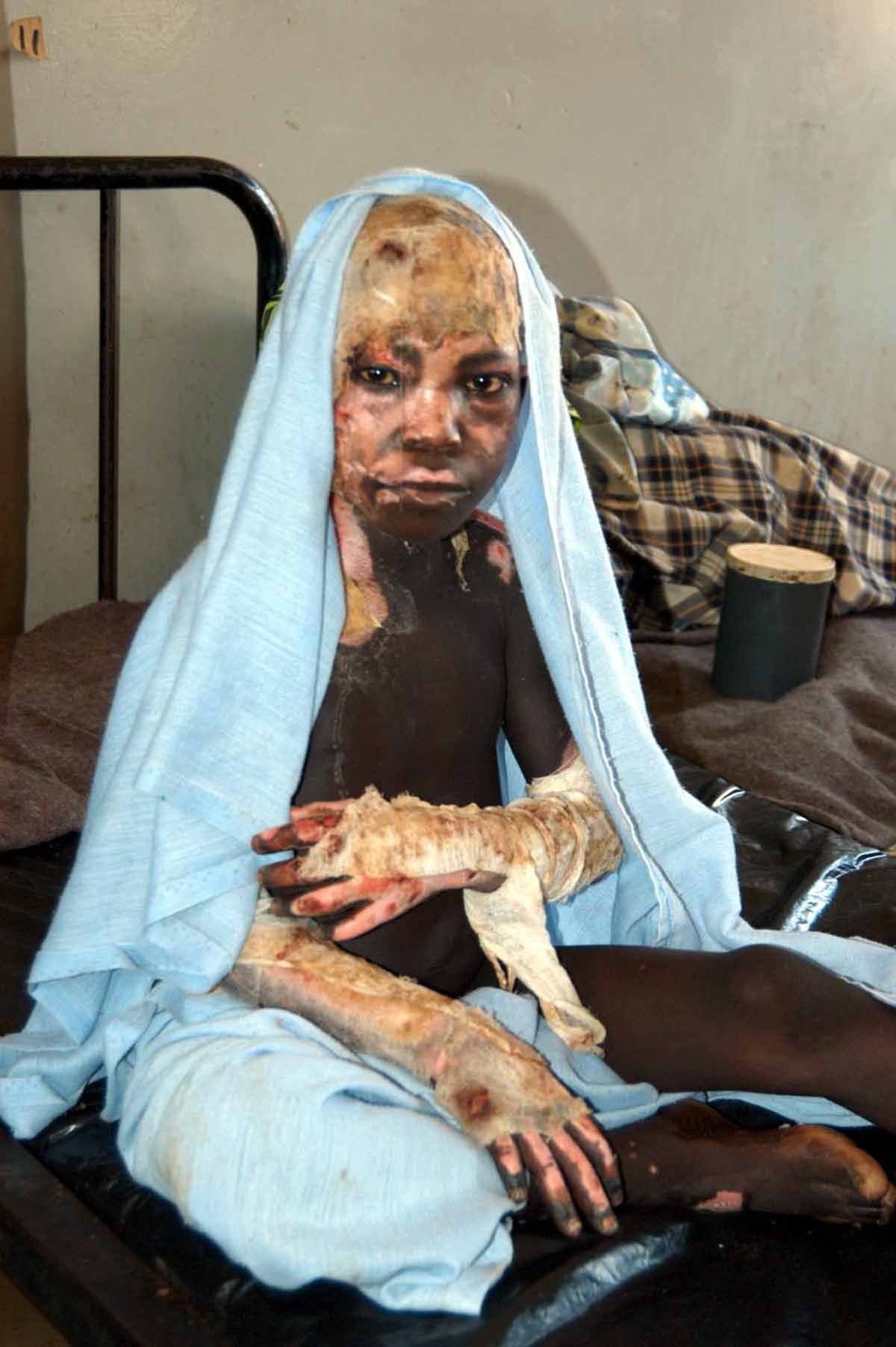 A victim of the Lord's Resistance Army (LRA) rebel 21 February 2004 attack sits 23 February 2004 at one of the Internally Displaced Camp hospital in the northern Lira district.