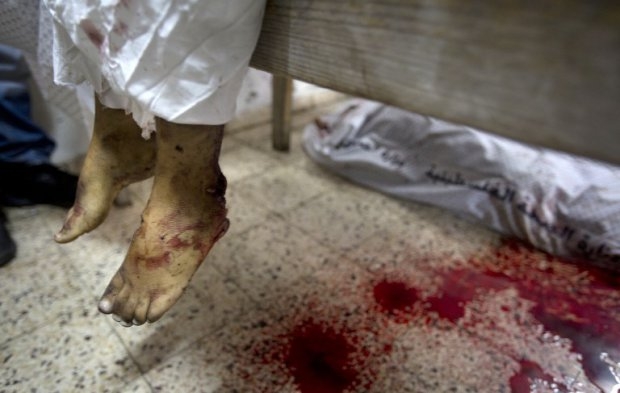 The bloodied legs of a dead child are seen in the morgue at the al-Shifa hospital in Gaza City, on July 20, 2014. The bloodied legs of a dead child are seen in the morgue at the al-Shifa hospital in Gaza City, on July 20, 2014.